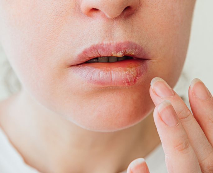 Опухла губа: причины и лечение