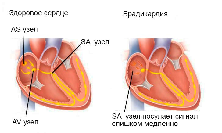 Синусовая брадикардия