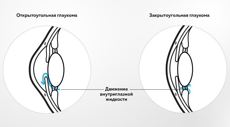 Формы глаукомы