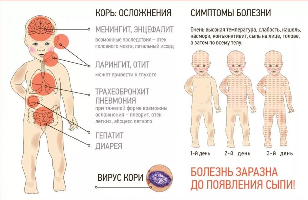 Симптомы и осложнения кори