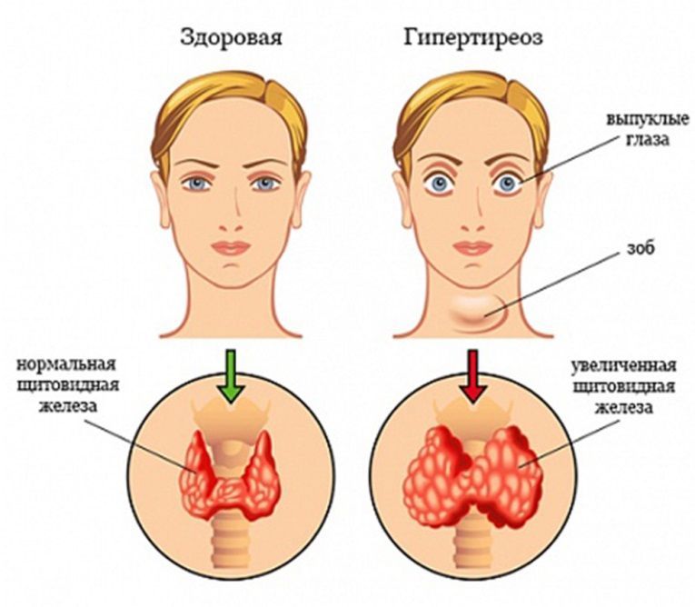 Что такое гипертиреоз