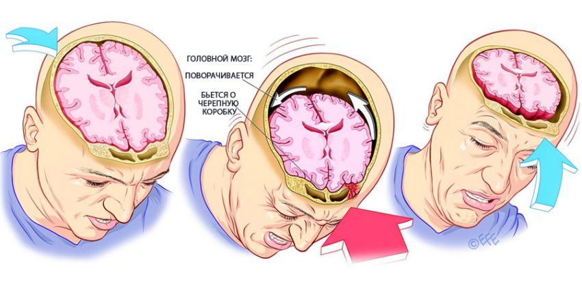 Что такое сотрясение головного мозга