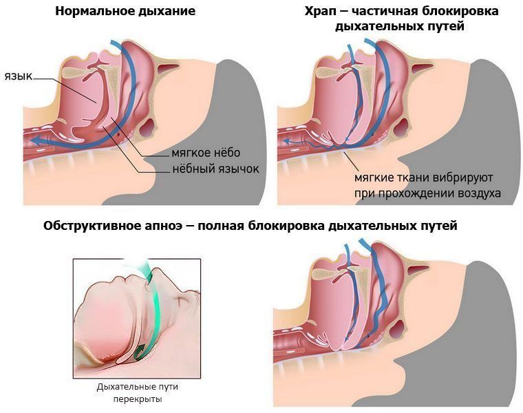 Апноэ