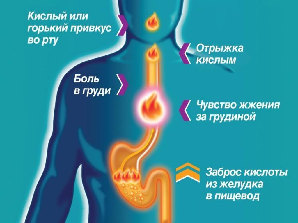 Симптомы изжоги