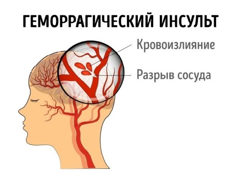 Геморрагический инсульт Геморрагический инсульт