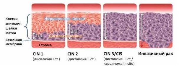 Дисплазия что это простыми словами. Смотреть фото Дисплазия что это простыми словами. Смотреть картинку Дисплазия что это простыми словами. Картинка про Дисплазия что это простыми словами. Фото Дисплазия что это простыми словами