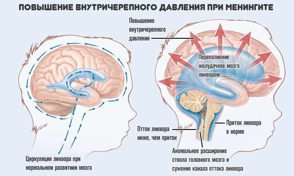 Диета при гидроцефалии мозга