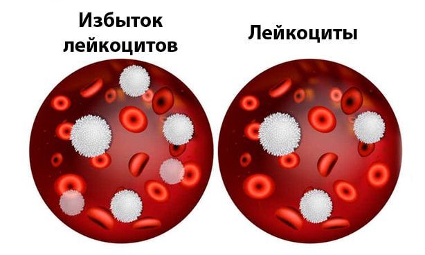 Повышенные лейкоциты в слизи