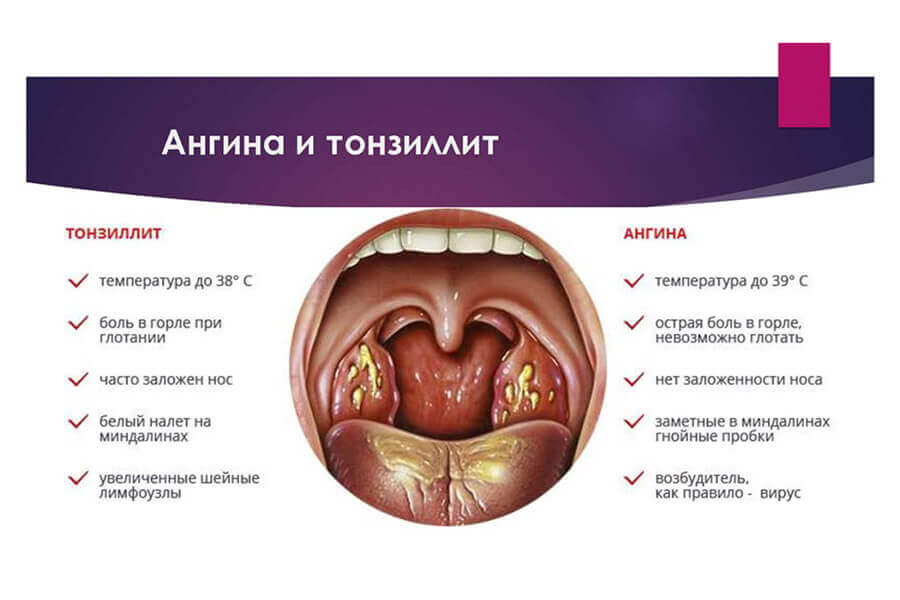 Как Выглядит Ангина Фото