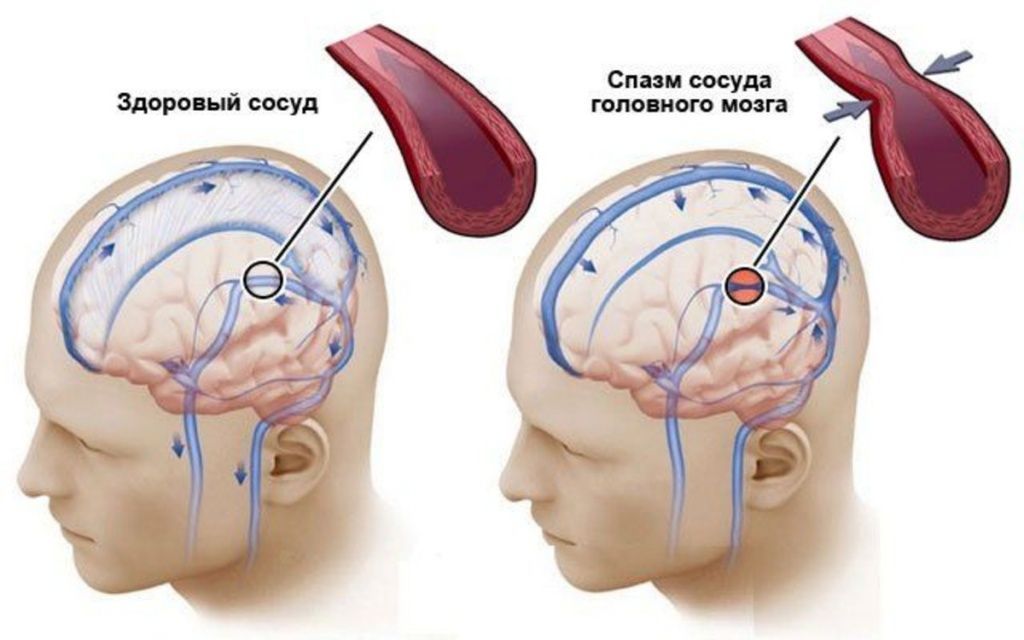 Болит голова спазм. Спазм сосудов головного мозга. Сосудистый спазм головного мозга. Патология сосудов головного мозга.