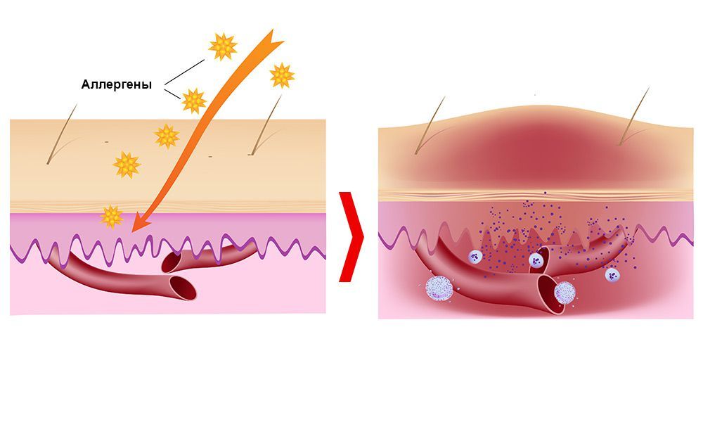 Зуд при аллергии