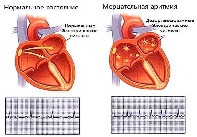 Что такое мерцательная аритмия