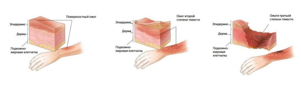 Ожоги по степени тяжести Ожоги по степени тяжести