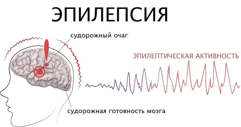 Что такое эпилепсия