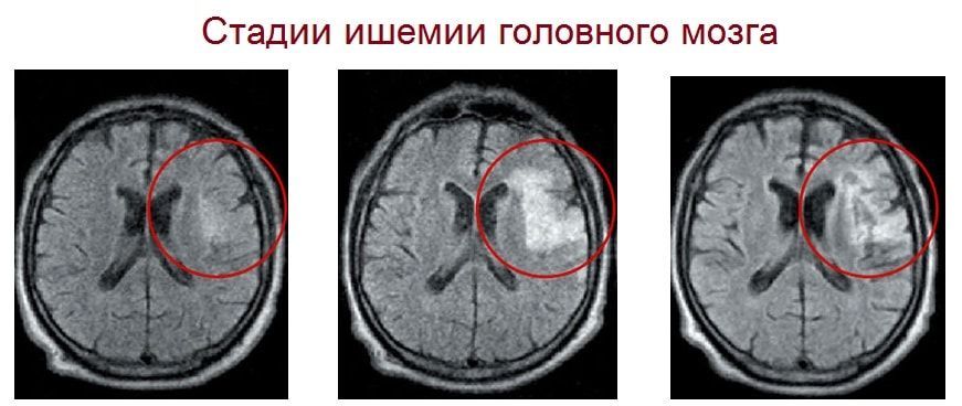 Инсульт 2 степени