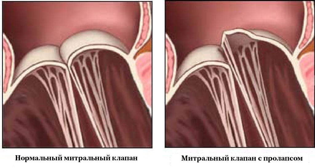 Пролапс митрального клапана