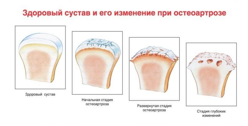 Изменения при остеоартрозе Изменения при остеоартрозе