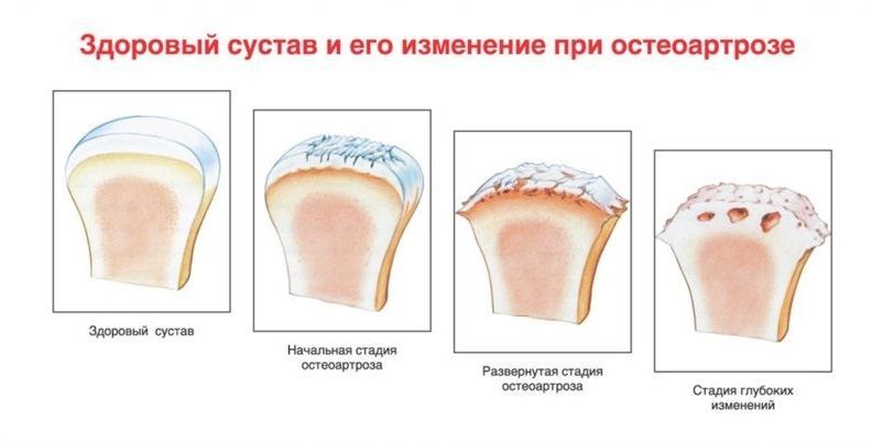 Изменения при остеоартрозе