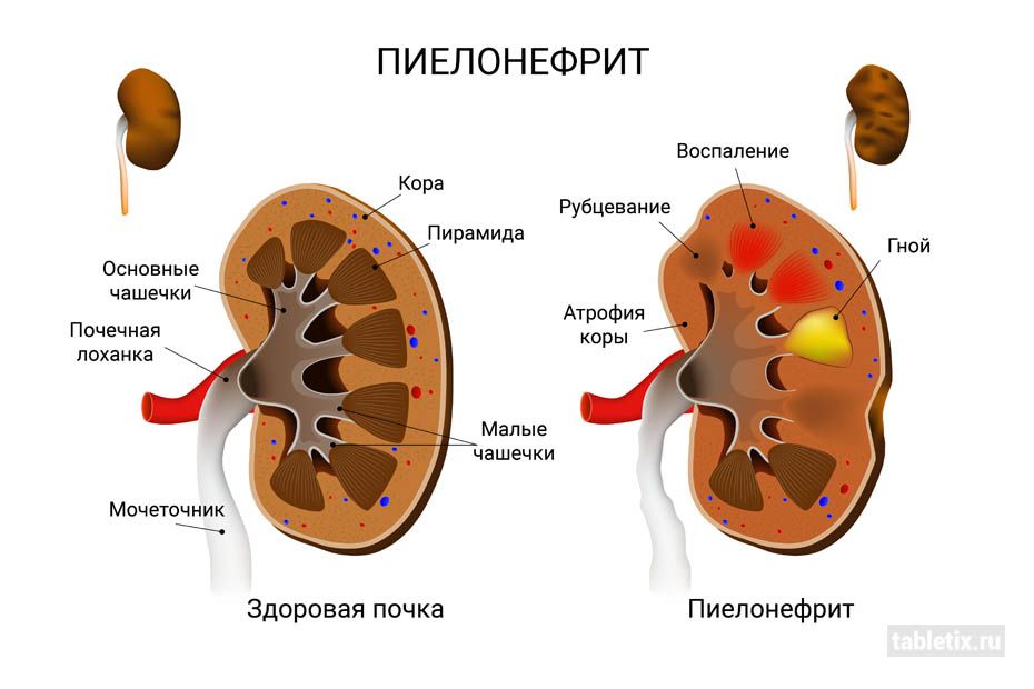 Пиелонефрит