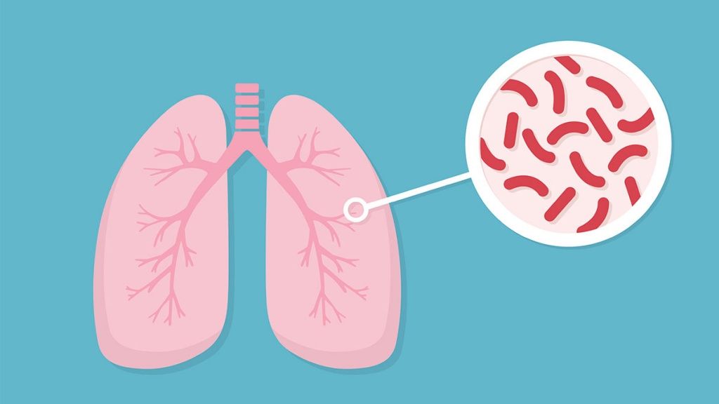 Что такое туберкулез легких
