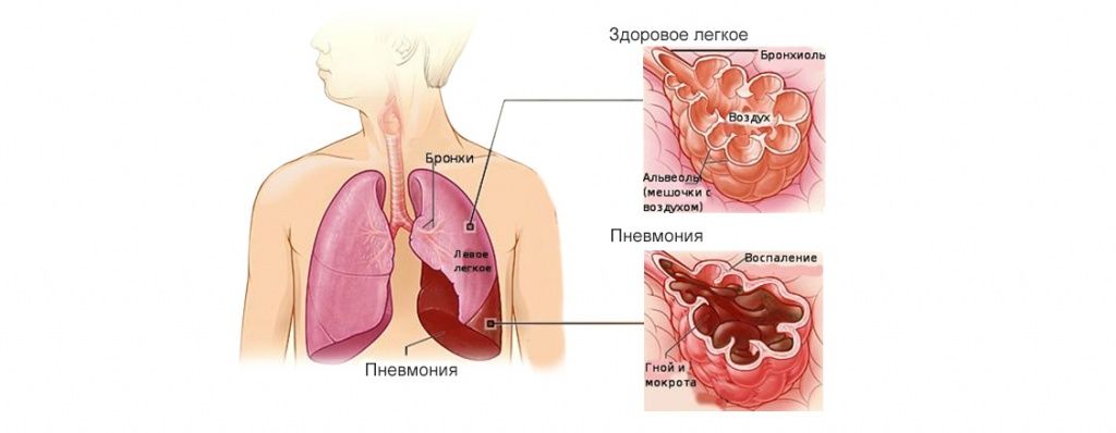 Чем опасна двусторонняя пневмония. Смотреть фото Чем опасна двусторонняя пневмония. Смотреть картинку Чем опасна двусторонняя пневмония. Картинка про Чем опасна двусторонняя пневмония. Фото Чем опасна двусторонняя пневмония