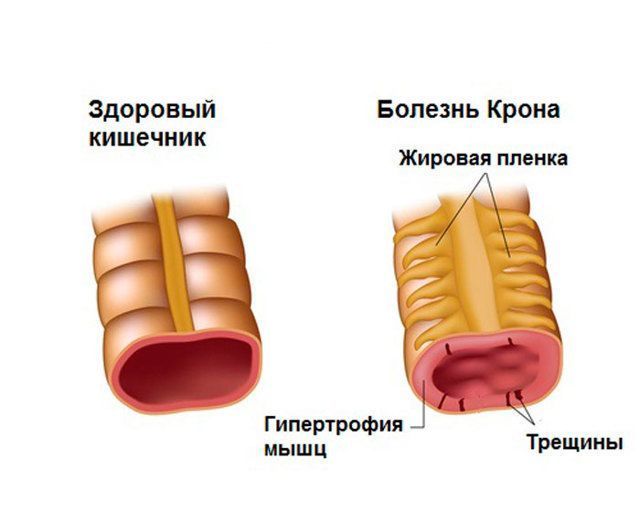 Болезнь Крона