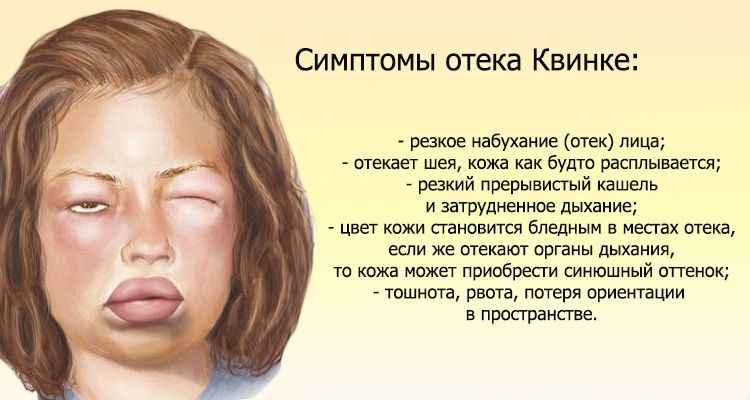 Симптомы отека Квинке