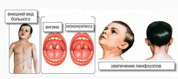 Симптомы мононуклеоза Симптомы мононуклеоза