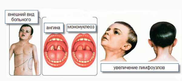 Лечение инфекционного мононуклеоза ~【Киев】