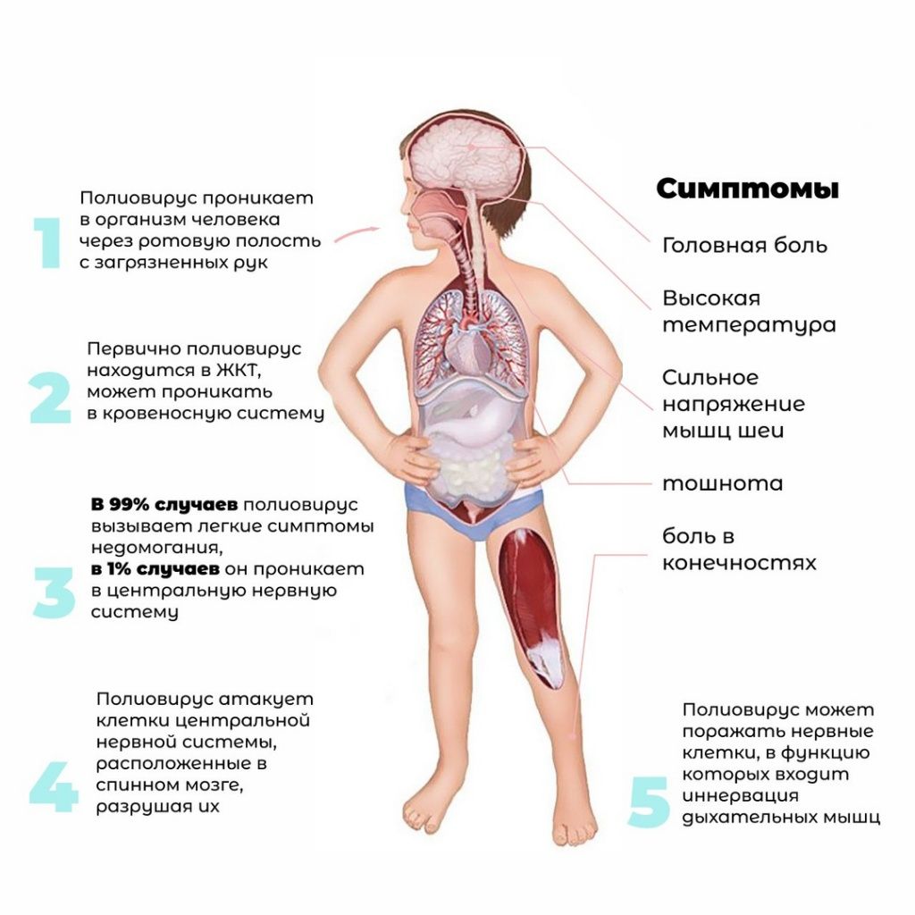 Симптомы полиомиелита