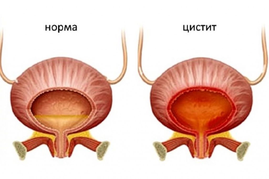 Симптомы цистита