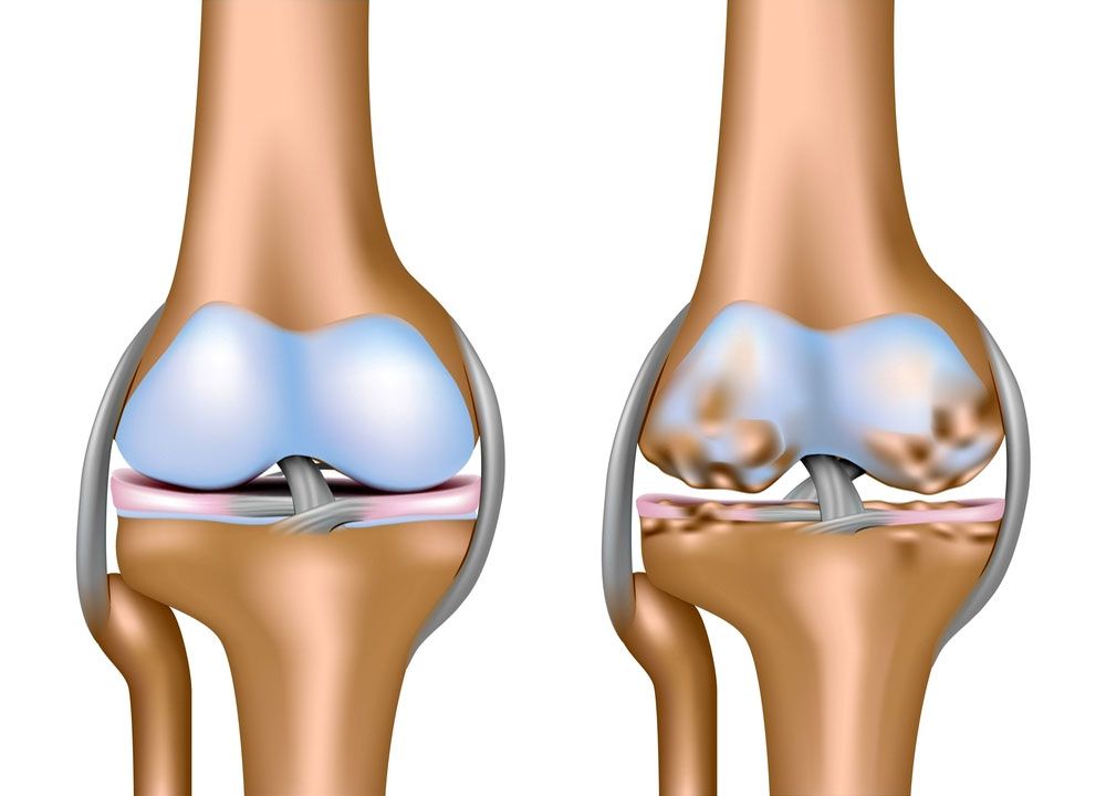 Развитие остеоартроза
