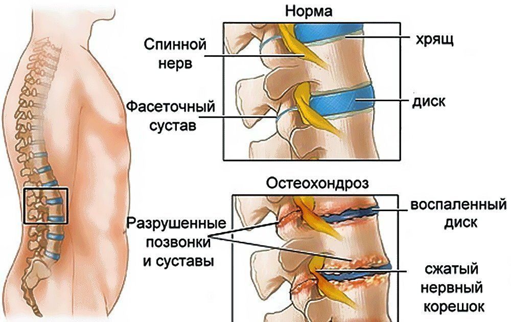 Как себя проявляет остеохондроз