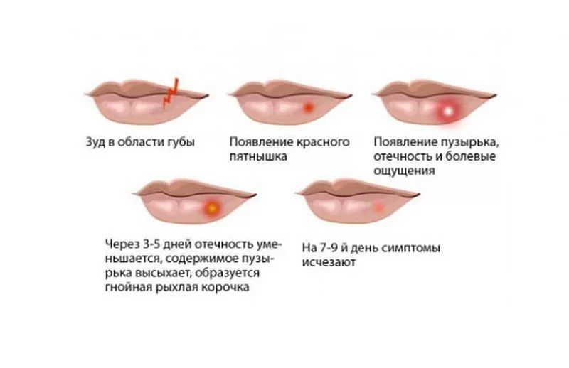Симптомы герпеса на губах