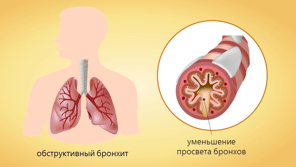 Причины обструктивного бронхита у детей