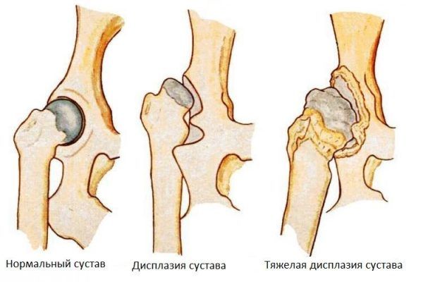 Дисплазия что это простыми словами. Смотреть фото Дисплазия что это простыми словами. Смотреть картинку Дисплазия что это простыми словами. Картинка про Дисплазия что это простыми словами. Фото Дисплазия что это простыми словами