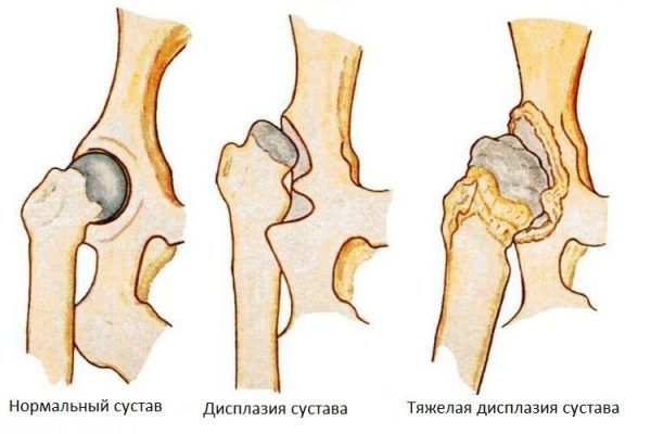 Дисплазия тазобедренного сустава