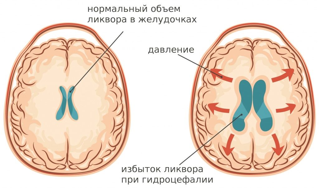 Гидроцефалия у ребенка Гидроцефалия у ребенка