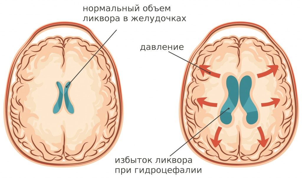 Гидроцефалия у ребенка