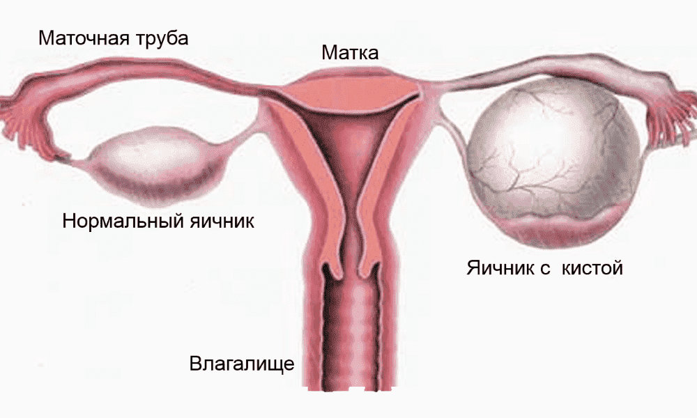 Киста яичника