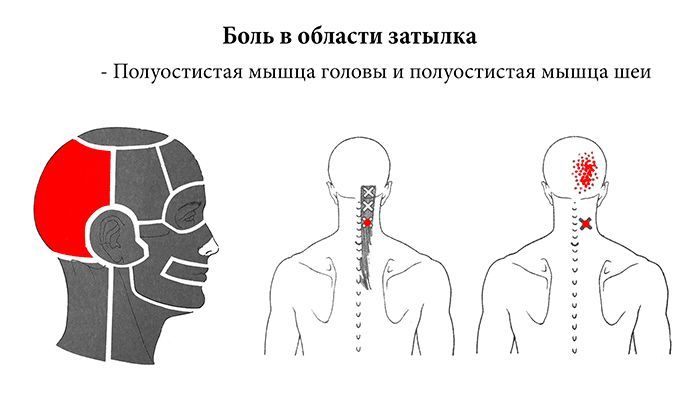 Почему болит затылок