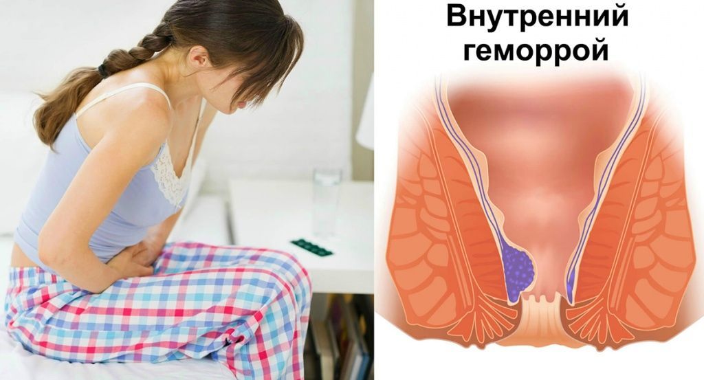 Симптомы внутреннего геморроя