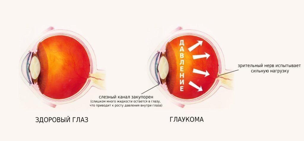 Следствие повышенного внутриглазного давления - Глаукома
