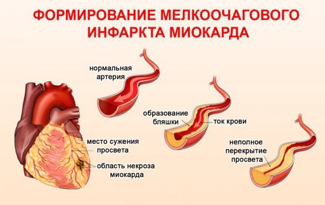 Причины микроинфаркта