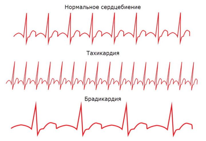 Что такое брадикардия
