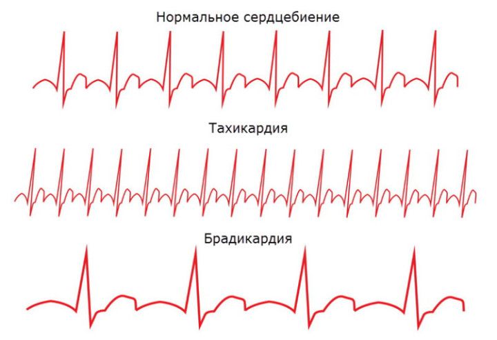 Что такое брадикардия