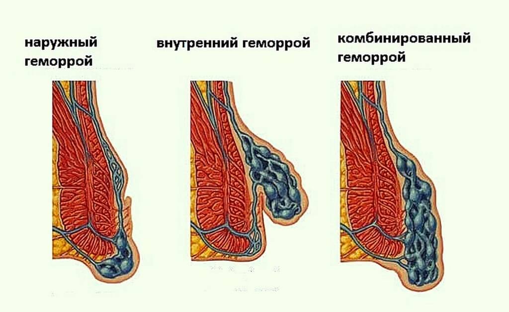 Виды геморроя