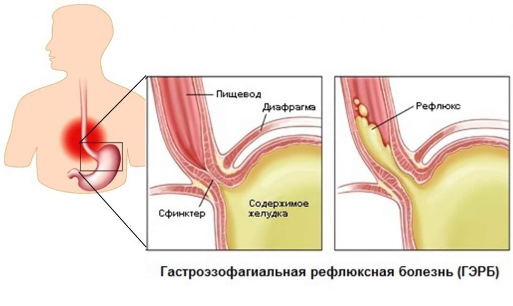 Гастроэзофагеальная рефлюксная болезнь