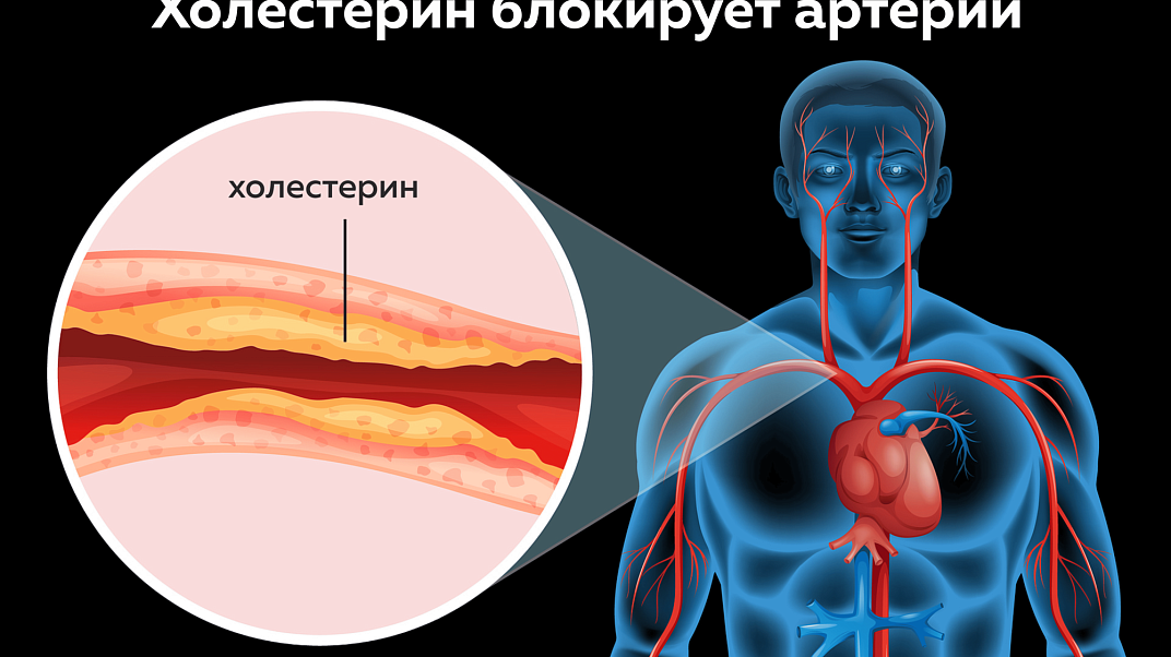Холестерин, плохой и хороший: нормы и отклонения